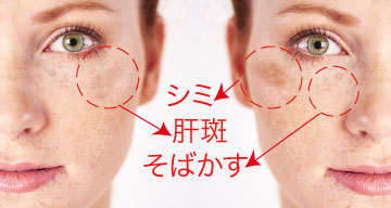 肝斑とは?他のシミとの違い
